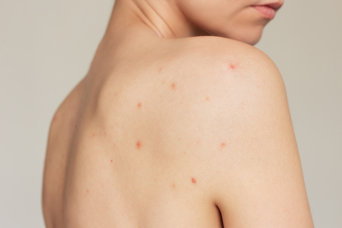 How to tackle acne on your body
